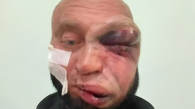 Драка у бара в Новосибирске закончилась трепанацией черепа