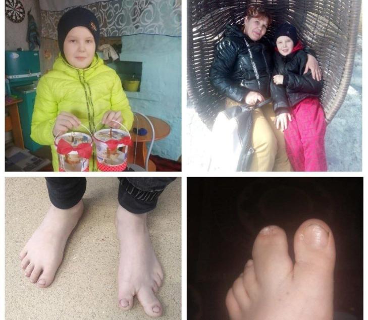 Гигантский палец мальчика в пять раз уменьшили врачи в Новосибирске