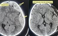 От комы до разрыва почки – как травмируются упавшие с электросамокатов дети