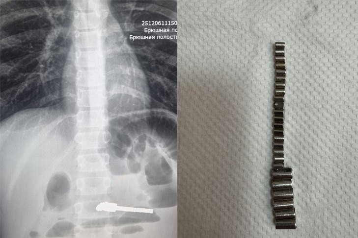 25 инородных тел достали из мальчика в Новосибирске