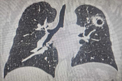 Житель Новосибирска выжил после трех случаев рака и двух операций