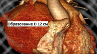 Новосибирские хирурги спасли женщину с огромным шаром на сердце