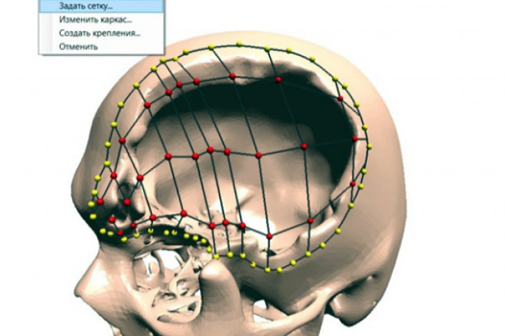 Программу для 3D-имплантатов на черепе разработали в НГТУ 