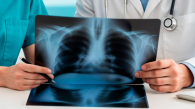 ИИ помогает выявлять туберкулёз у новосибирцев