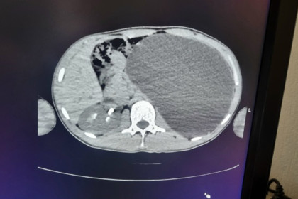 Почку с пятилитровую бутыль обнаружили на УЗИ у юноши в Новосибирске