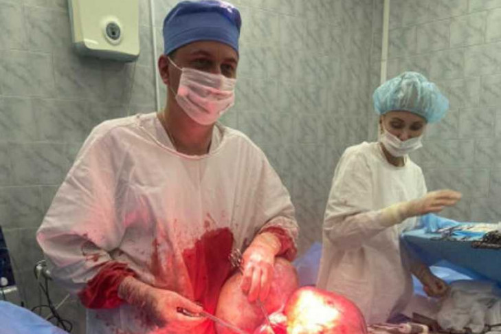 Чужой: хирурги сфотографировали гигантские опухоли в животе сибирячки