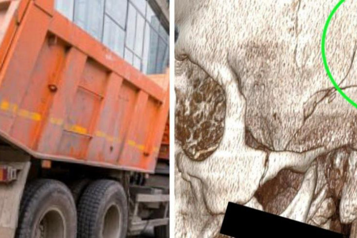 Коробка передач от КамАЗа проломила черепную коробку новосибирца