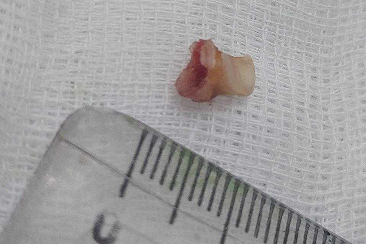 В Новосибирске врачи спасли мальчика с выпавшим молочным зубом в бронхах